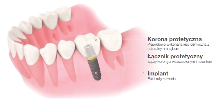 implant